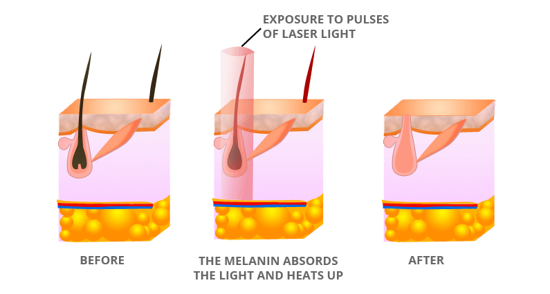 What-is-laser-hair-removal-1